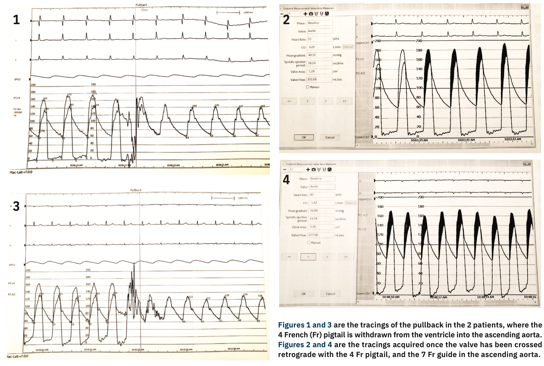 Mother and Child Technique For Aortic Stenosis